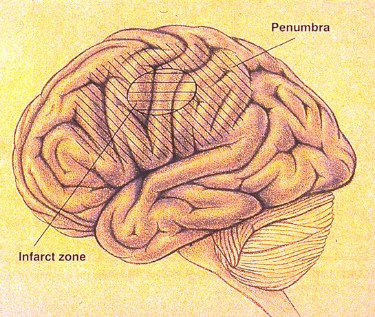 Brain Ischemia Regional ischemia: Pancellular necrosis Anemic infarct Hemorrhagic infarct