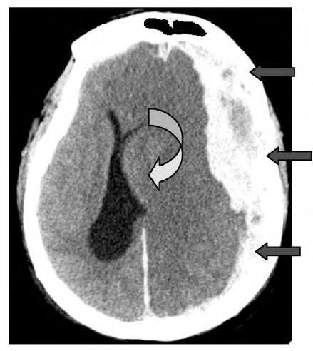 MASS EFFECT Radiographic signs of mass effect 1) Sulcal effacement 2) Ventricular