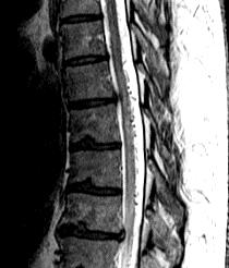 Spinal dural AVF Enlarged edematous cord Prominent flow voids on cord surface Vessels enhance