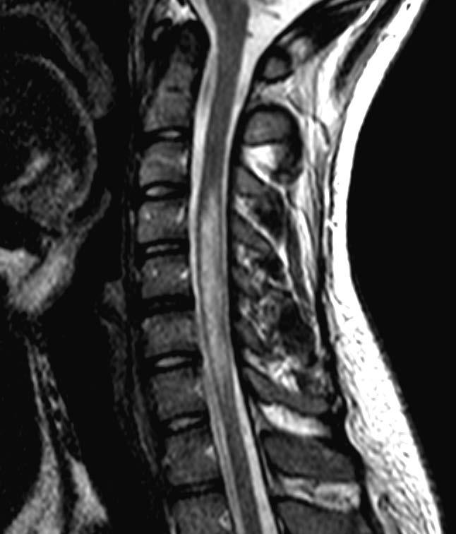 Transverse myelitis: DDx MS: Generally < 2 vertebral segments Neoplasm: Edema, cystic ±