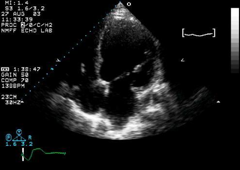 Cardiac Imaging in MI Echocardiography Nuclear