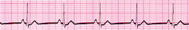 25. Your patient is suffering from hypoxia secondary to a bacterial pneumonia. Using the six-second method, interpret the rhythm strip obtained during assessment: a. Sinus tachycardia b.
