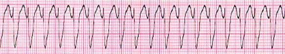 Which medication would be administered first for this patient given the following vital signs: B/P 88/60, Respiratory rate 28, and pulse oximetry of 96%. a. Atropine 0.5 1.0 mg b.