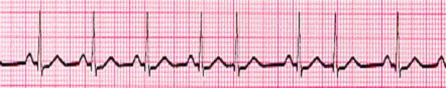 level of consciousness but responds to painful stimulus. Your first intervention based on the ECG recording and assessment findings is to: a. Administer lidocaine at 1 1.5 mg/kg b.