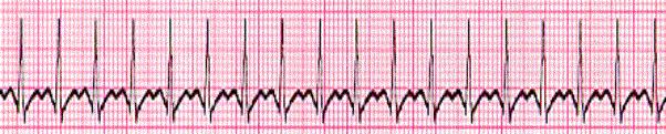 During the course of your assessment you obtain the following ECG tracing and interpret it to be: a. Normal sinus rhythm b. Sinus rhythm with PJC s c. Sinus rhythm with PAC s d.