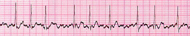 d. Adenosine 6 mg 38. Interpret the following ECG: a. Atrial flutter b. Atrial fibrillation c. Atrial tachycardia d. Sinus tachycardia 39.