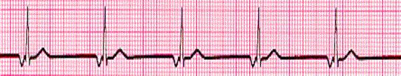 The likelihood of an inferior myocardial infarction d. The chance of an aortic aneurysm 40. Interpret the following ECG: a. Normal sinus rhythm b. Sinus bradycardia c. Sinus dysrhythmia d.