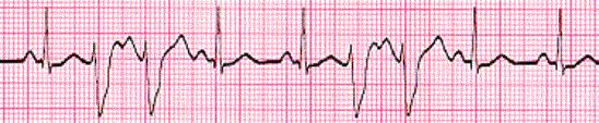42. For the patient in the previous question, you obtained an ECG tracing and found the following rhythm. What is your interpretation? a. Sinus rhythm with PAC s b.
