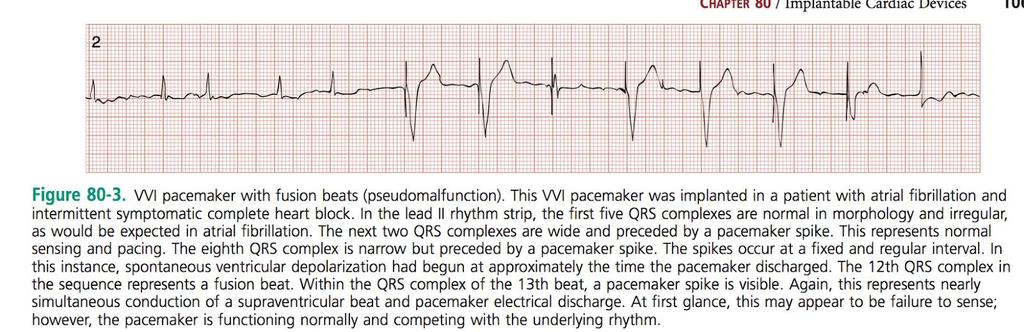 6) What is pacemaker syndrome, which type of pacer is most commonly involved, and what is the treatment?
