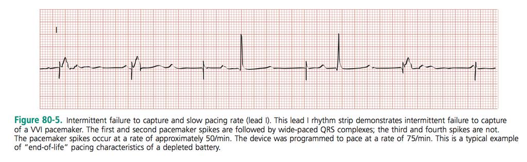 2) What is Twiddler s syndrome? According to LITFL Patient manipulation of the pulse generator (accidentally or deliberately).