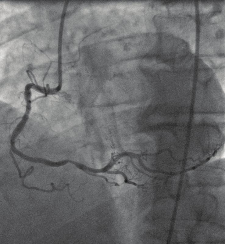 Coronary angiogram A coronary angiogram may be done during or after a heart attack or angina. It s sometimes called cardiac catheterisation.