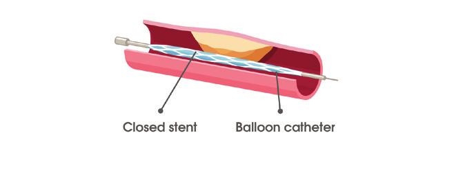 Common medical procedures Some common procedures and treatments are explained below. Coronary angioplasty and stent implantation This is a procedure to open a narrowing in your artery.