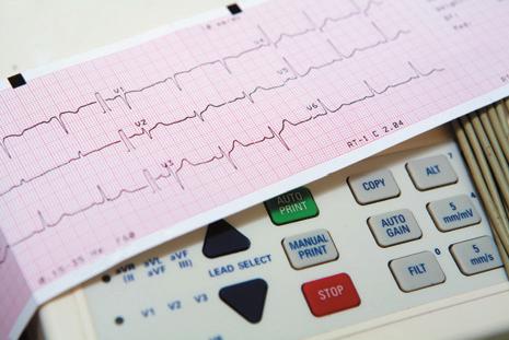 Electrocardiogram (ECG) Over the years, the ECG has been developed to become one of the most important tests in the investigation of heart-related problems.