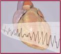Myocardial Infarction Type 3 Cardiac death with symptoms suggestive of myocardial ischaemia and presumed new ischaemic ECG changes or new LBBB, but death occurring before