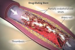 Myocardial Infarction Type 4b Myocardial infarction related to stent-thrombosis is detected by coronary angiography or autopsy in