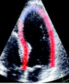 Imaging Evidence of Acute Myocardial Infarction Imaging evidence of new loss of viable myocardium or new regional
