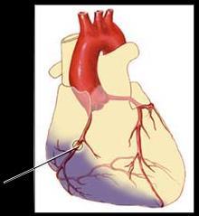 area a myocardial infarction.