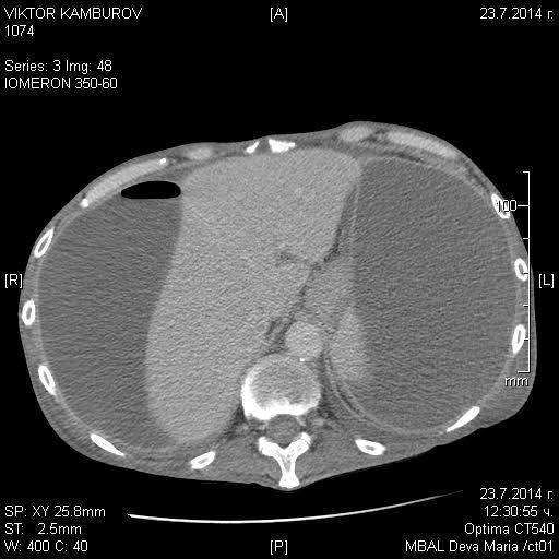 Figure 1 and 2. Preoperative CT Concerning the poor general condition of the patient the planned operative procedure was video assisted retroperitoneal debridement.