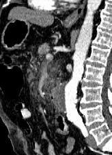 Revised Definitions of Acute Pancreatitis Old term: mild AP New term: non-severe AP 80% of all patients with AP Histology Interstitial edema,