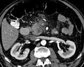 Pancreatitis Clinical question: ruptured AAA?