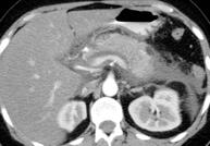 Morphology on CECT or MRI Acute Necrotizing Pancreatitis, Subtype 1 sed AFTER the first week Etiology: hyperlipidemia Acute interstitial or