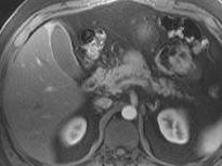 MRI Assessment of Acute Pancreatitis MRI Assessment of Acute Pancreatitis MRI as efficient as CT in