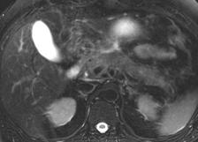Sensitivity of MRI may surpass CT (minor peripancreatic inflammation) on T2w images (Pamuklar, Magn