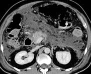 extension of necrosis and exacerbation of renal impairment after iv iodine contrast media?