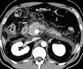 system using secretin MRCP Known biliary stones, minor peripancreatic inflammation Fluid Collections
