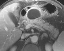 otherwise normal appearing pancreas CT: