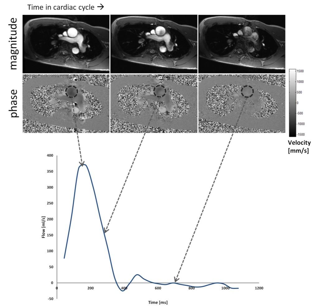 16 Figure 2.3 Magnitude and phase images with through plane velocity encoding from a series of 2D phase contrast images collected throughout the cardiac cycle.