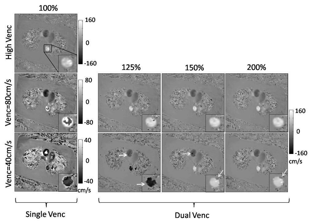 61 significant phase errors remain in the vessels when only 25% of the high Venc data is used for unwrapping. Figure 3.7 Example high, low and dual V enc PC VIPR images.