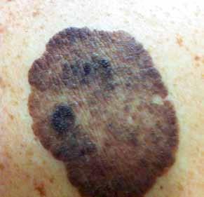 How To TREAT from page 27 ation in susceptible individuals. These lesions are pre-malignant.