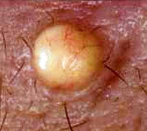 The individual lesion may be flat and irregularly shaped with an adherent scale; some may develop a thick keratinous plaque or even a cutaneous horn (figure 5).