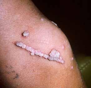 Many warts involute spontaneously within a period of about two years, but some may persist even after vigorous treatment.