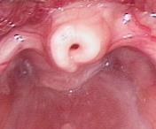 a Figure 2: Curled-up, omega-shaped epiglottis a b b Figure 4: Laryngomalacia secondary to