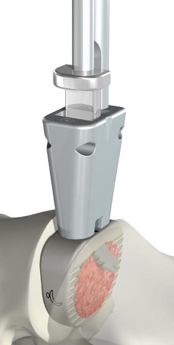 SURGICAL TECHNIQUE ROI-A Insert First Plate and Advance Keep Implant Holder in