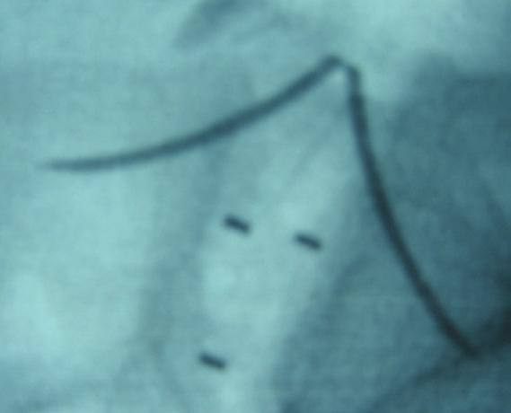 anterior-posterior fluoroscopic