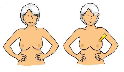 There are different signs of breast cancer you
