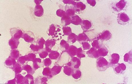 Streptococcus pneumoniae or pneumococci).