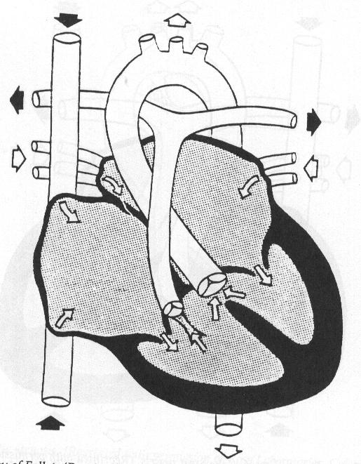 Tetralogy of Fallot VSD Over-riding aorta Pulmonary valve stenosis
