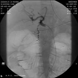 artery. The catheter tip is advanced into the right gastroepiploic artery and on pulling back the catheter the gastroduodenal artery complex is completely occluded by eleven fiber coils (fig. 2b).
