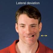 Lateral deviation side to side movement The