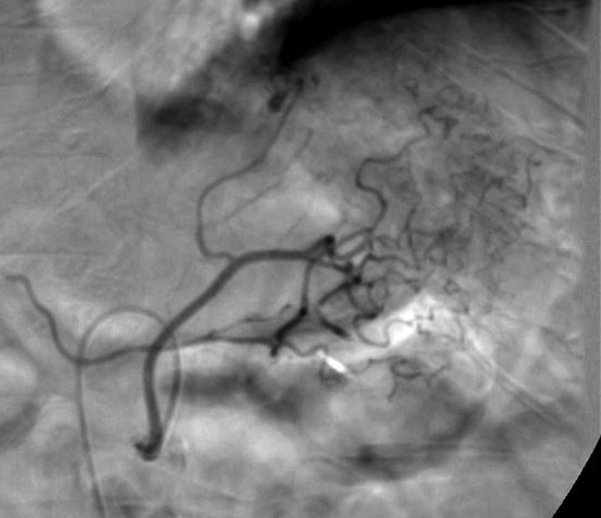 Left gastric artery angiography does not show any bleeding