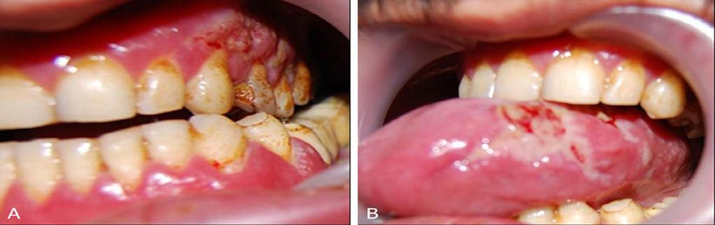 Figure 1: Khat leaves Figure 2: Plasma cell gingivitis affecting gingiva and tongue. A: Edematous and erythematous gingiva with some erosions.
