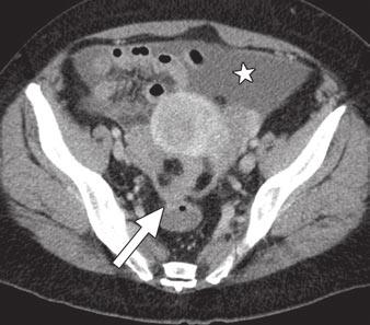 , orresponding axial T image shows presence of both ascites and peritoneal carcinomatosis (arrow). determination of the best treatment strategy.