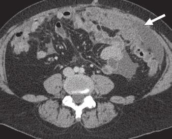 Moreover, it has a poor negative predictive value [8]. T has been the standard imaging technique for evaluation of suspected recurrence of ovarian cancer.