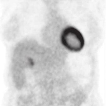 7 mm FDG-avid soft-tissue mass in liver, which is consistent with metastasis., orresponding coronal T image shows presence of metastatic lesion in liver (arrow).