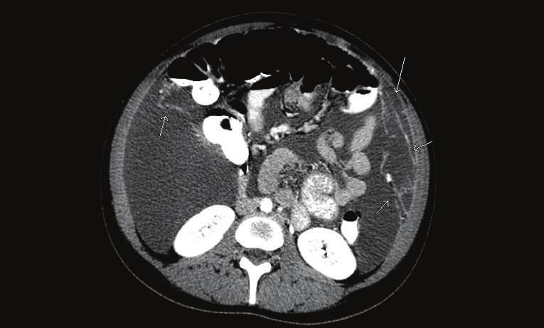 Case Reports in Obstetrics and Gynecology 3 Figure 3: CT scan of the abdomen and pelvis revealing a significant amount of ascites and enhancing predominantly linear soft tissue densities in the right