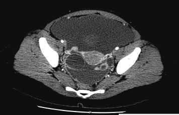 4 cm, respectively, with multiple other nodules in both adnexa, peritoneal thickening, and abdominopelvic ascites.